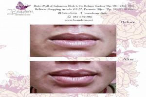 Lips Filler / Filler Bibir